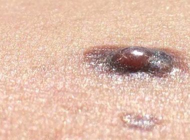 melanoma